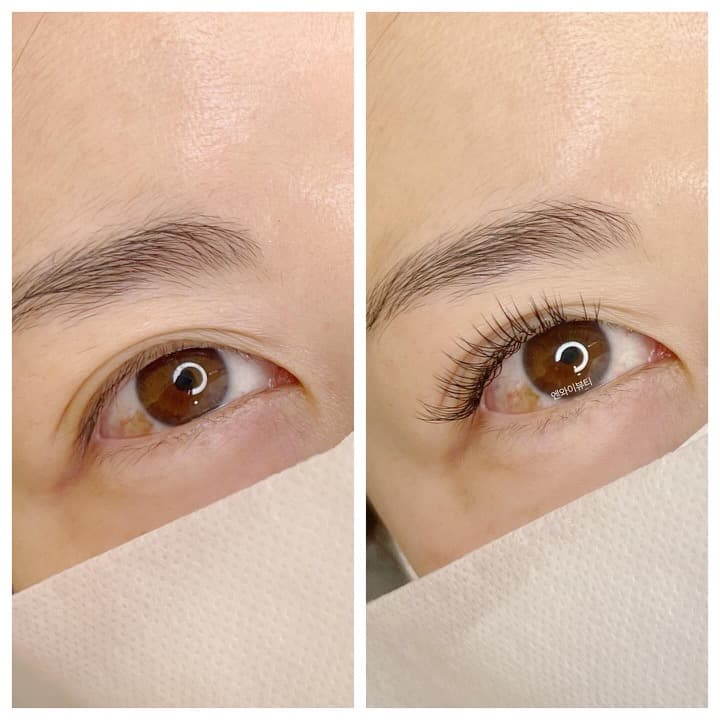 엔와이뷰티 시술 사진 2