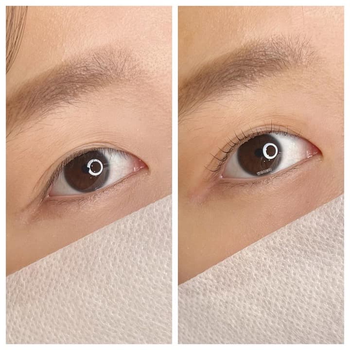 엔와이뷰티 시술 사진 3